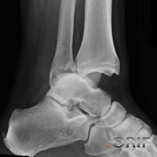 ankle dislocation xray