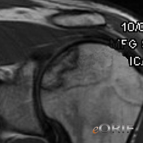 avascular necrosis humerus mri