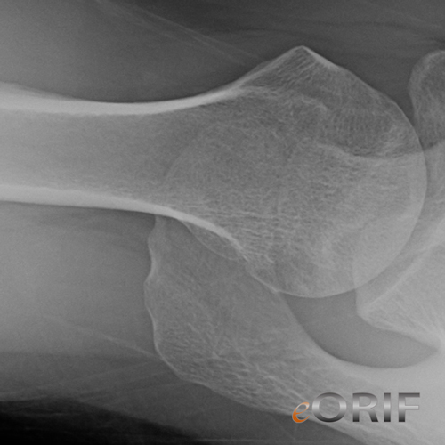 avascular necrosis humerus xray