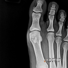  bipartite tibial sesamoid