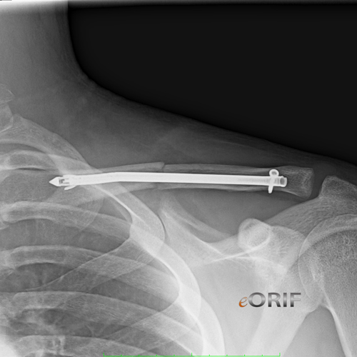 clavicle fracture sonoma nail