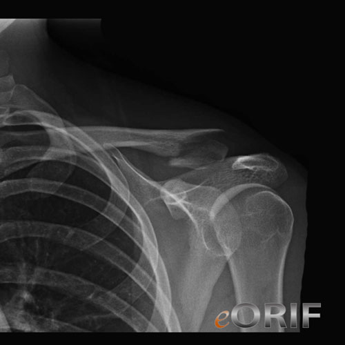 distal clavicle fracture xray