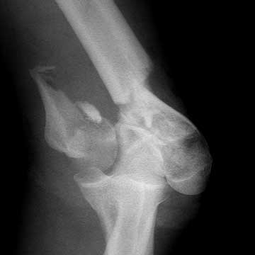 distal humerus fracture