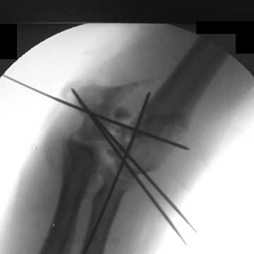 distal humerus fracture