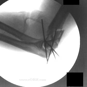 distal humerus fracture