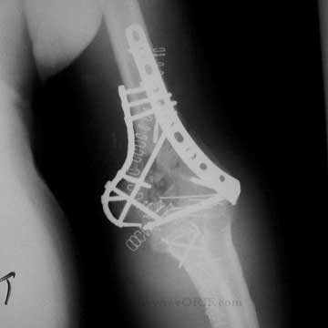 distal humerus fracture ORIF