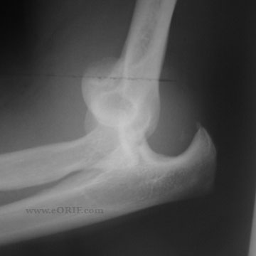 elbow dislocation xray