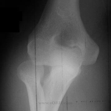 elbow dislocation xray