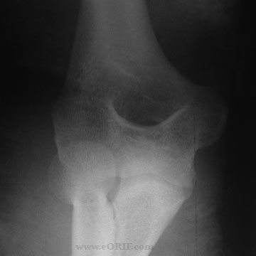 elbow dislocation xray