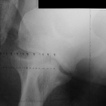 elbow dislocation xray