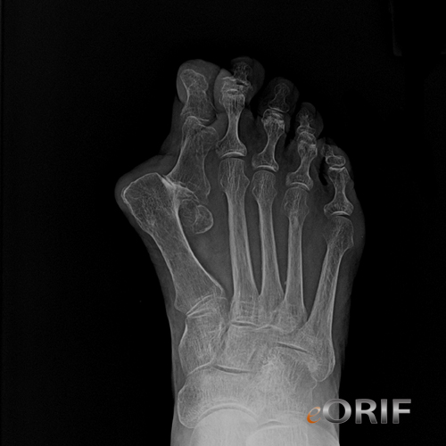 hallux valgus dislocation