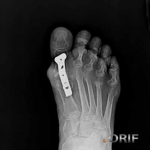 hallux MTP fusion