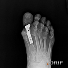 hallux MTP fusion