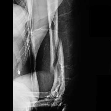 distal 1/3 humeral shaft fracture