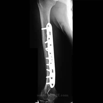 humeral shaft fracture ORIF