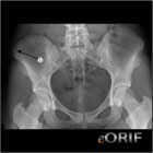 iliac apophysitis xray