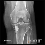 subchondroplasty xray