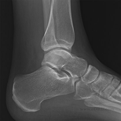 lateral malleolus fracture xray