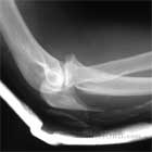 Olecranon Fracture xray