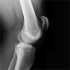 patella alta xray picture