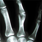 Phalanx fracture xray