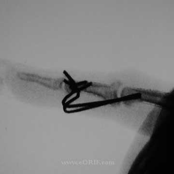 PIP joint external fixation xray