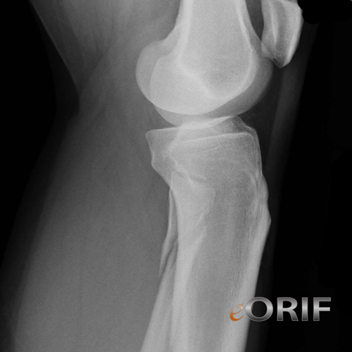 proximal fibular fracture