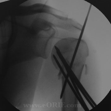 Proximal Humerus Fracture crpp xray