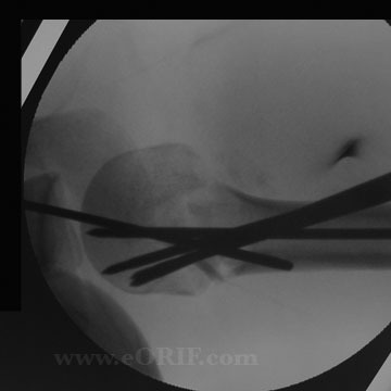 Proximal Humerus Fracture crpp xray