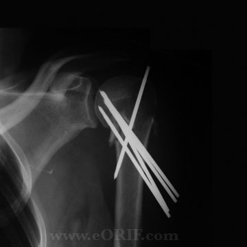 Proximal Humerus Fracture crpp xray