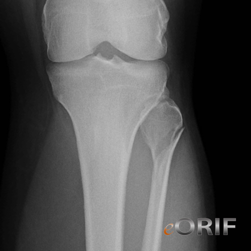 proximal fibula fracture