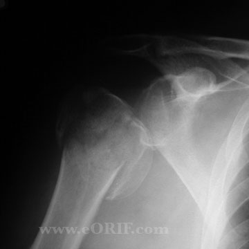 Proximal Humerus Fracture xray