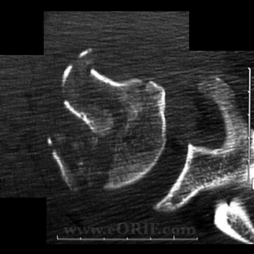 Proximal Humerus Fracture CT