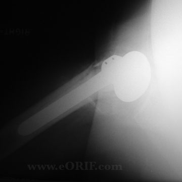 Proximal humeral hemiarthroplasty xray