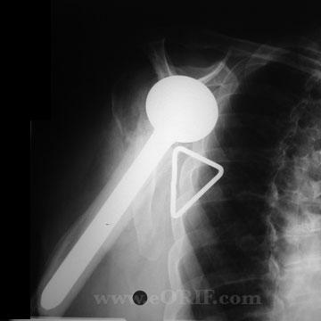 Proximal Humerus Fracture hemiarthroplasty