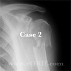 Proximal humerus fracture xray