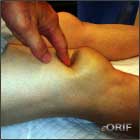 quad tendon rupture