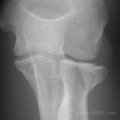 radial head fracture xray