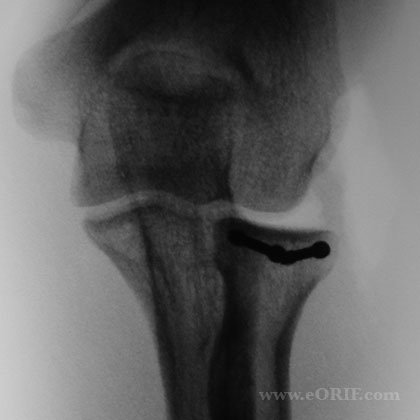 radial head fracture xray