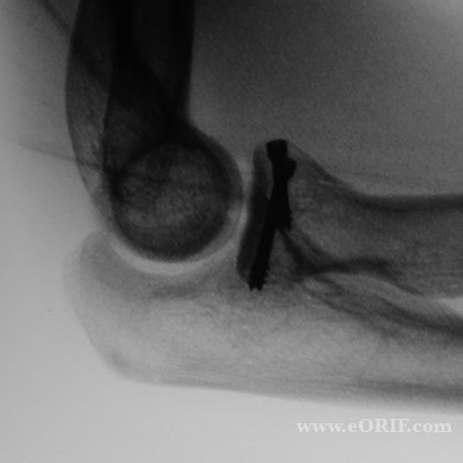 radial head fracture ORIF xray