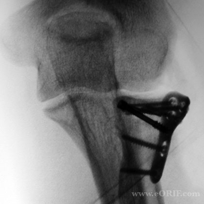 Radial Head Fracture ORIF xray