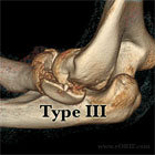 Radial Head Fracture Type III CT scan