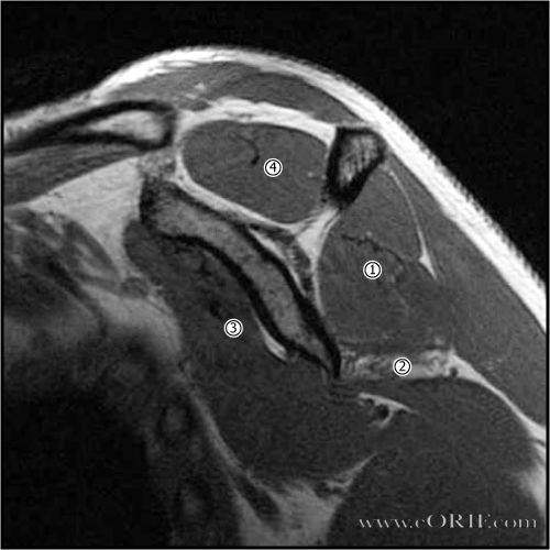 Teres atrophy MRI