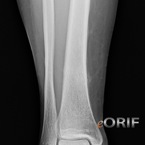 tibial shaft stress fracture xray