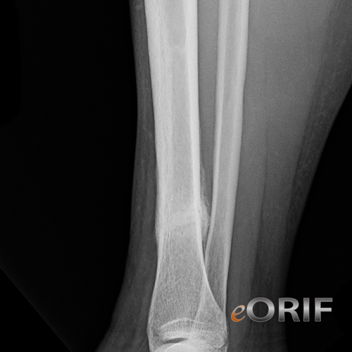 tibial shaft stress fracture xray