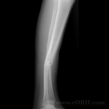 tibial shaft fracture nonunion xray