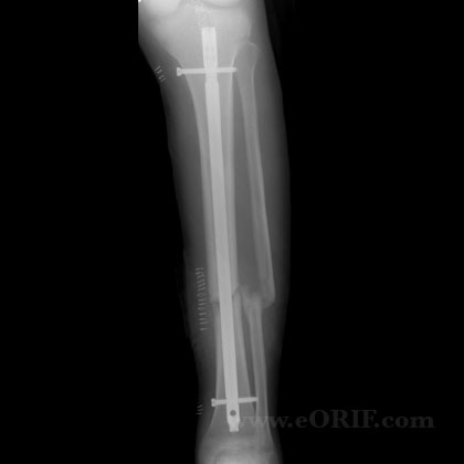 tibial shaft nonuion IM nail xray