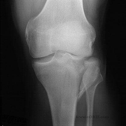 Schatzker Type II tibial plateau fracture xray