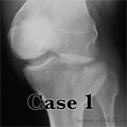 Tibial plateau fracture xray