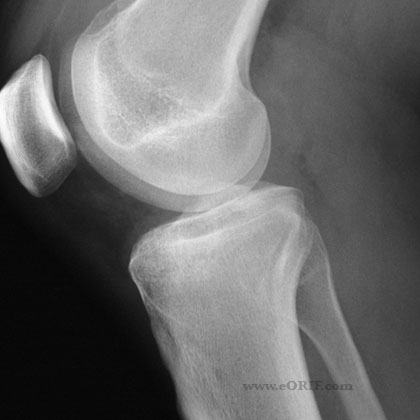 Schatzker Type II tibial plateau fracture xray